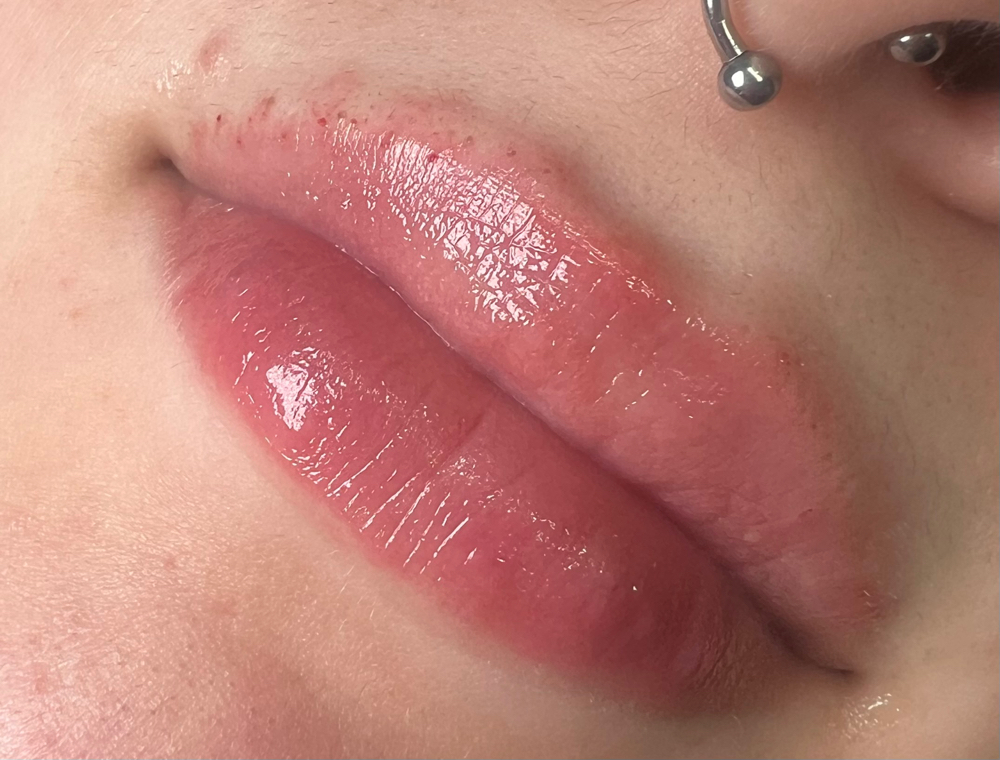 Lip Filler ( Hyaluron Pen)