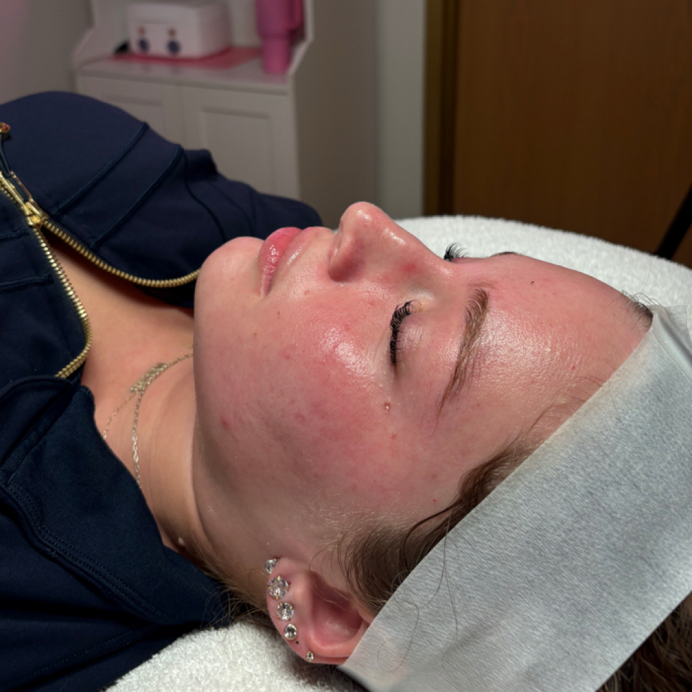 Dermaplane Deluxe at Ciaobella Esthetics in Avon, IN