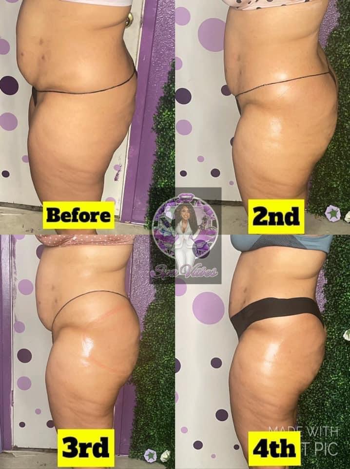 Non-Surgical BBL 45mins