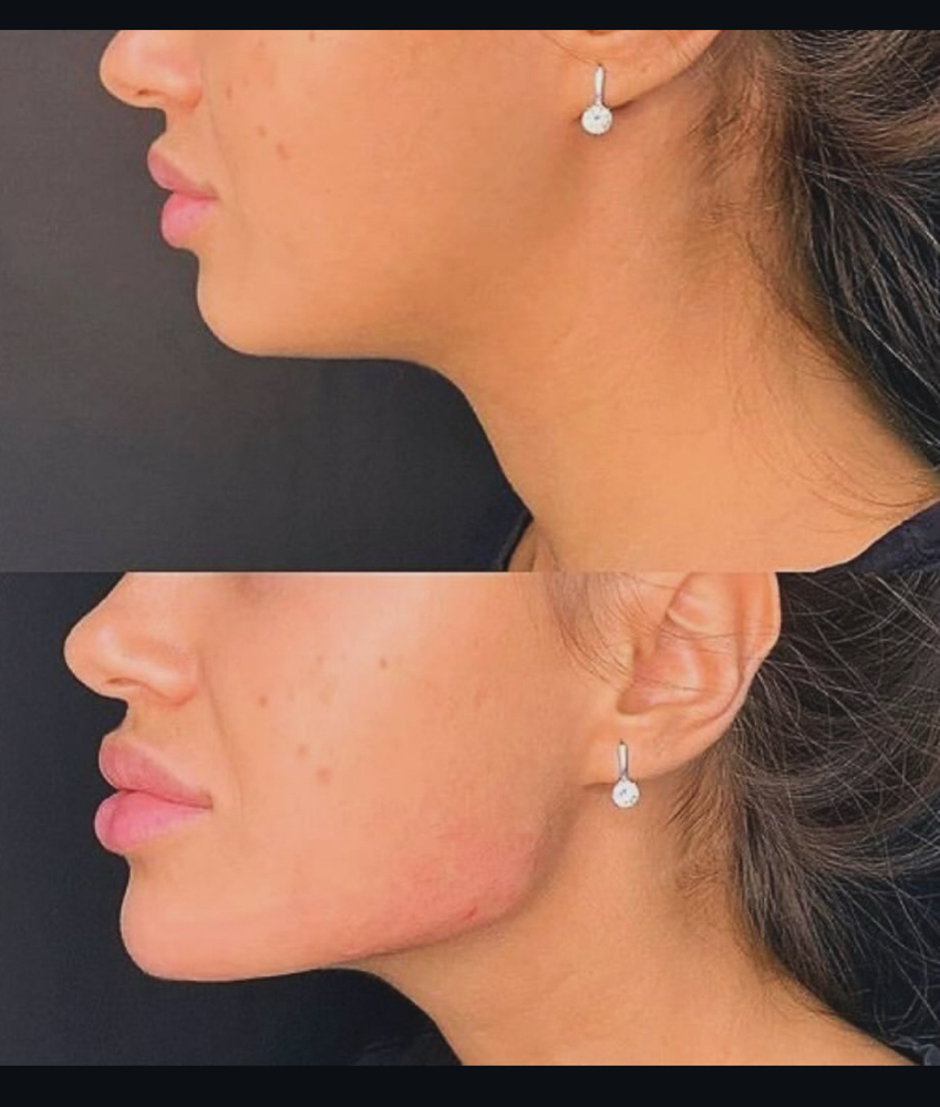 Jawline Filler