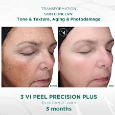 Precision Plus VI Chemical Peel!