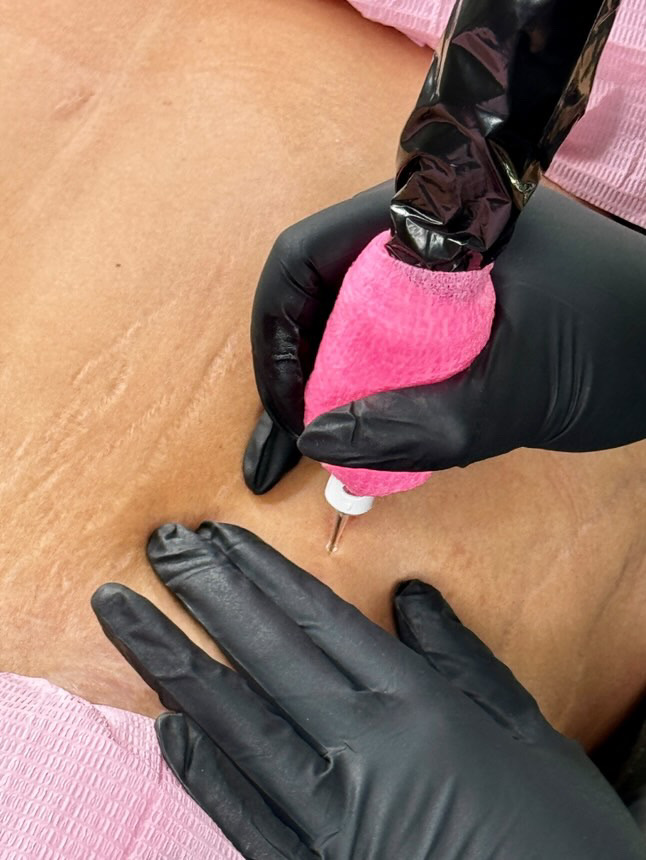 Inkless Stretch Mark Revision