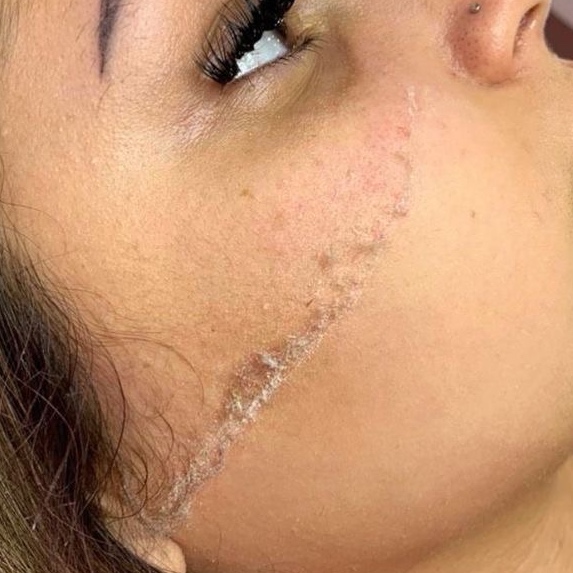 Dermaplaning at Shelby Langston in Brock, TX