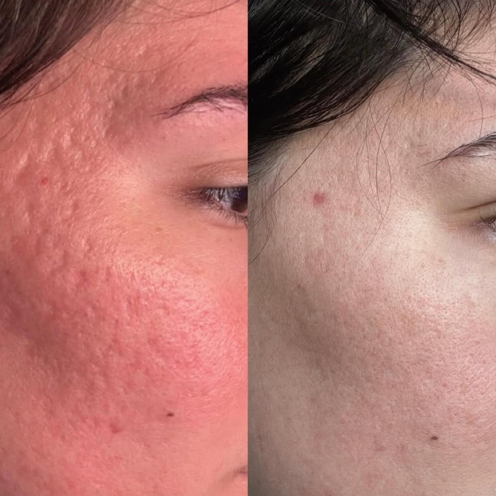 Microneedling With BioRePeel at Nicole Marie Aesthetics in Whitestone, NY