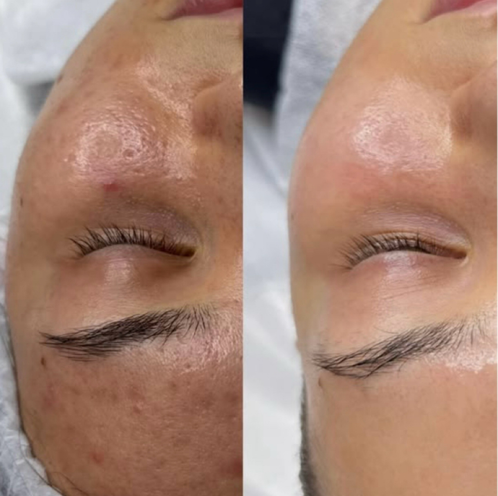 Acne Facial at Gardenias Beauty Salon in North Charleston, SC