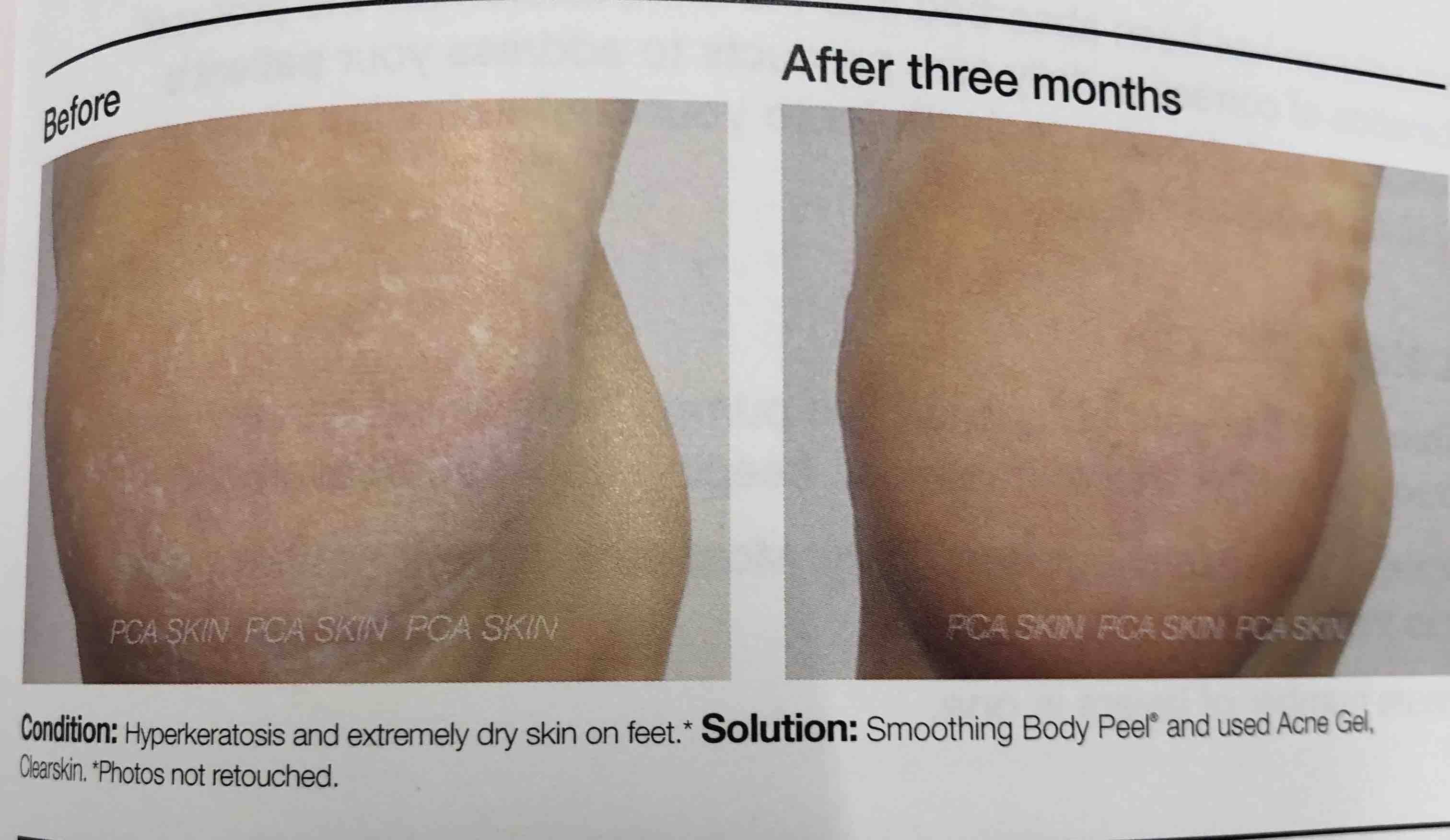 PCA Smoothing Body Peel Treatment