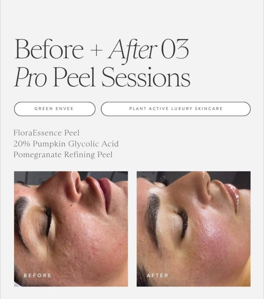 Series Of 3 Peels