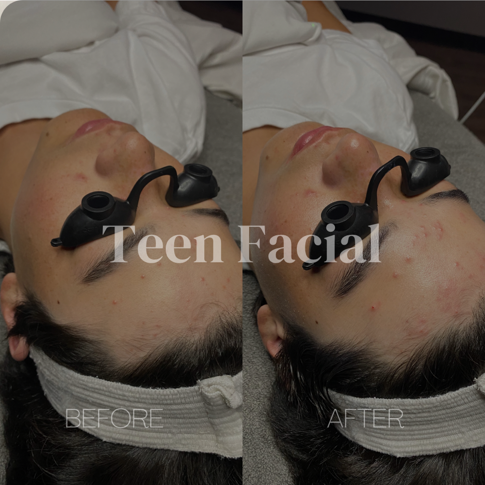Teen Care Facial