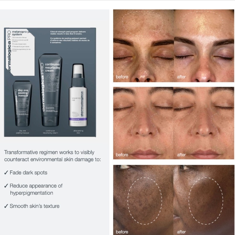 Melanopro Peel ( DARKSPOTS) at Facial Sensations in Lewisville, TX