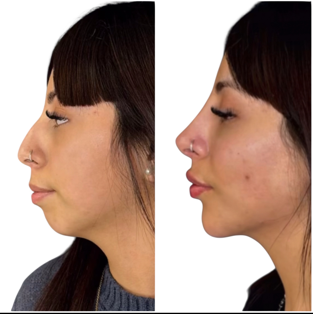 Nose Filler (Non-surgical Rhinopl)