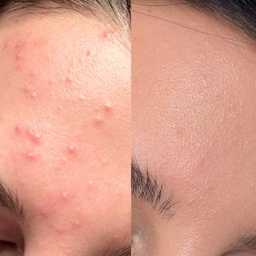 60 Minute Acne Bootcamp Facial at Charismatic Beauty in Apple Valley, CA