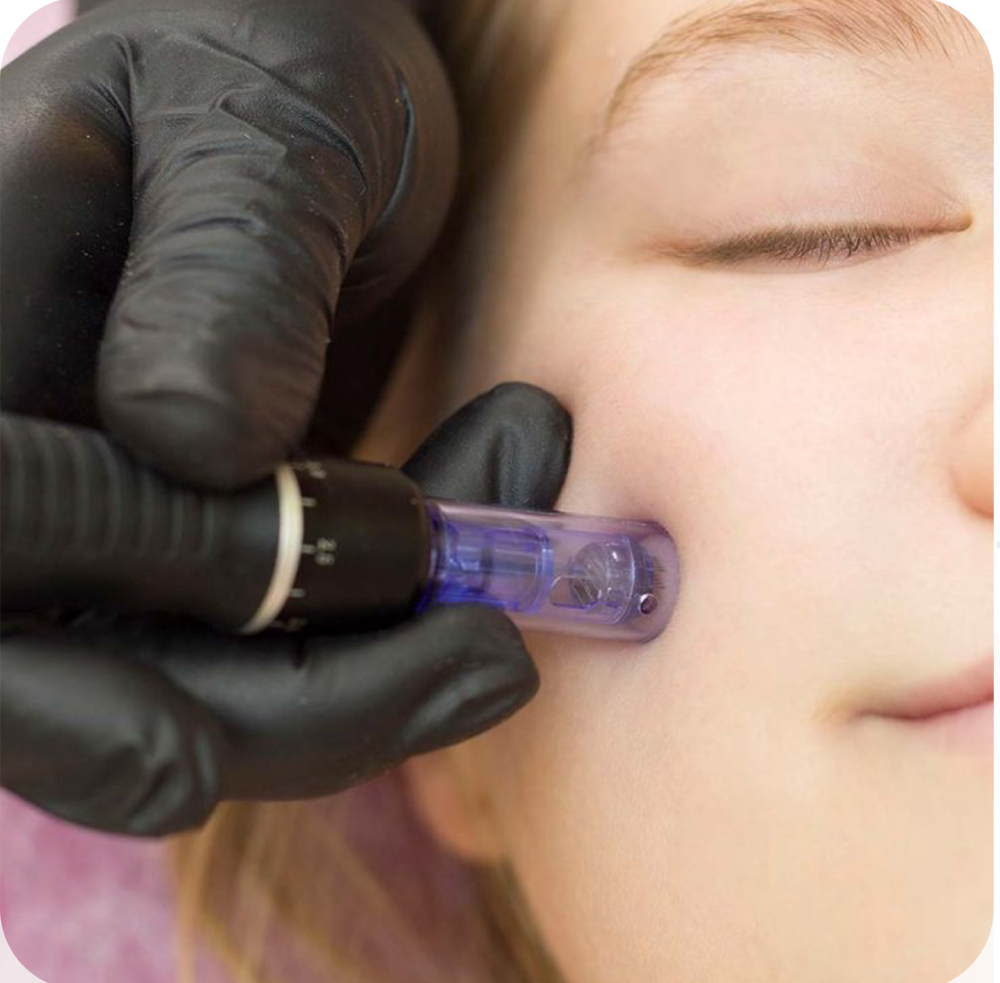 Nano Needle Facial