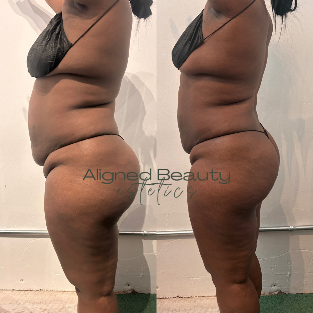 Cellulite Attack (Wood therapy)