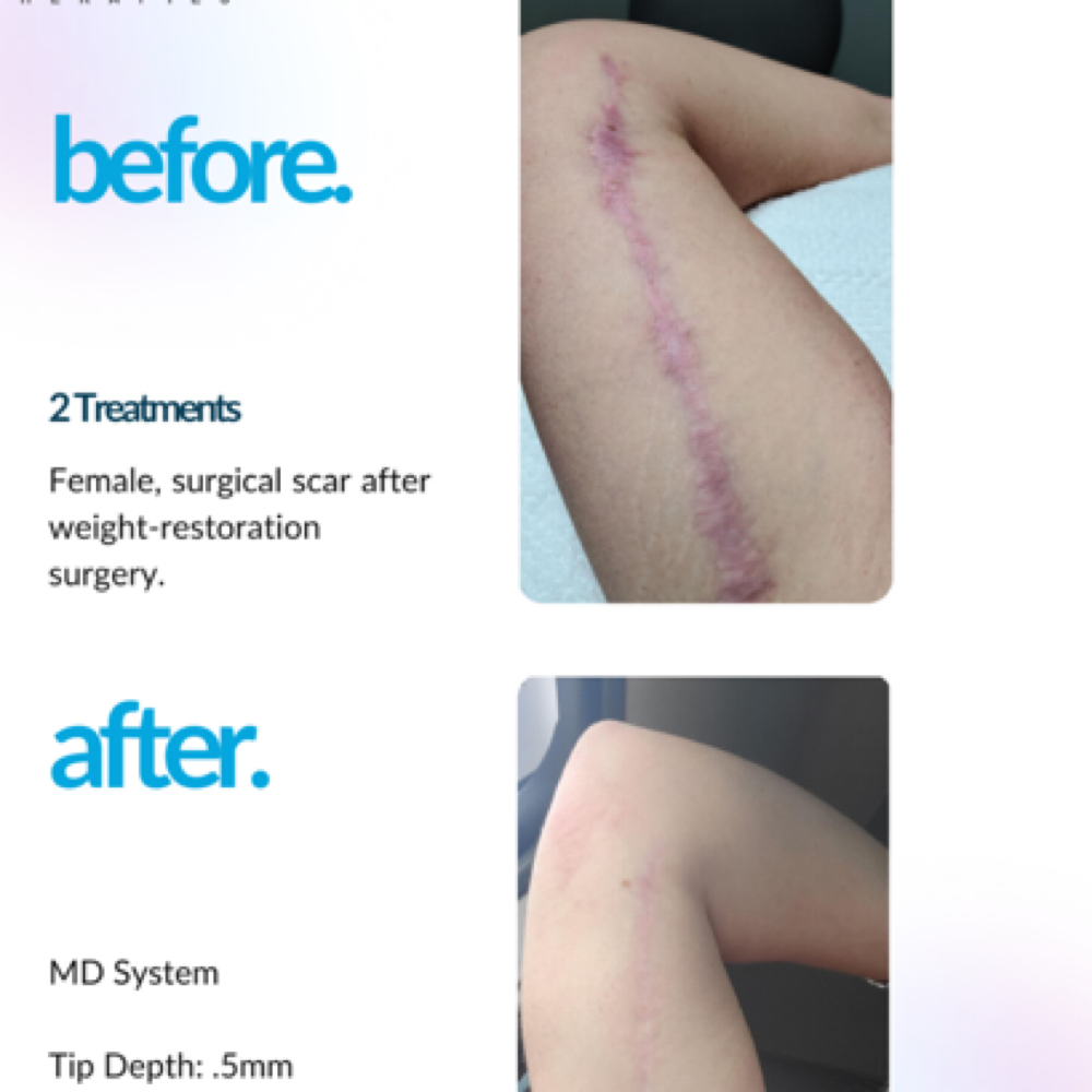 Body Microchanneling Treatment at Altar Beauty Co. by Yury in Payette, ID