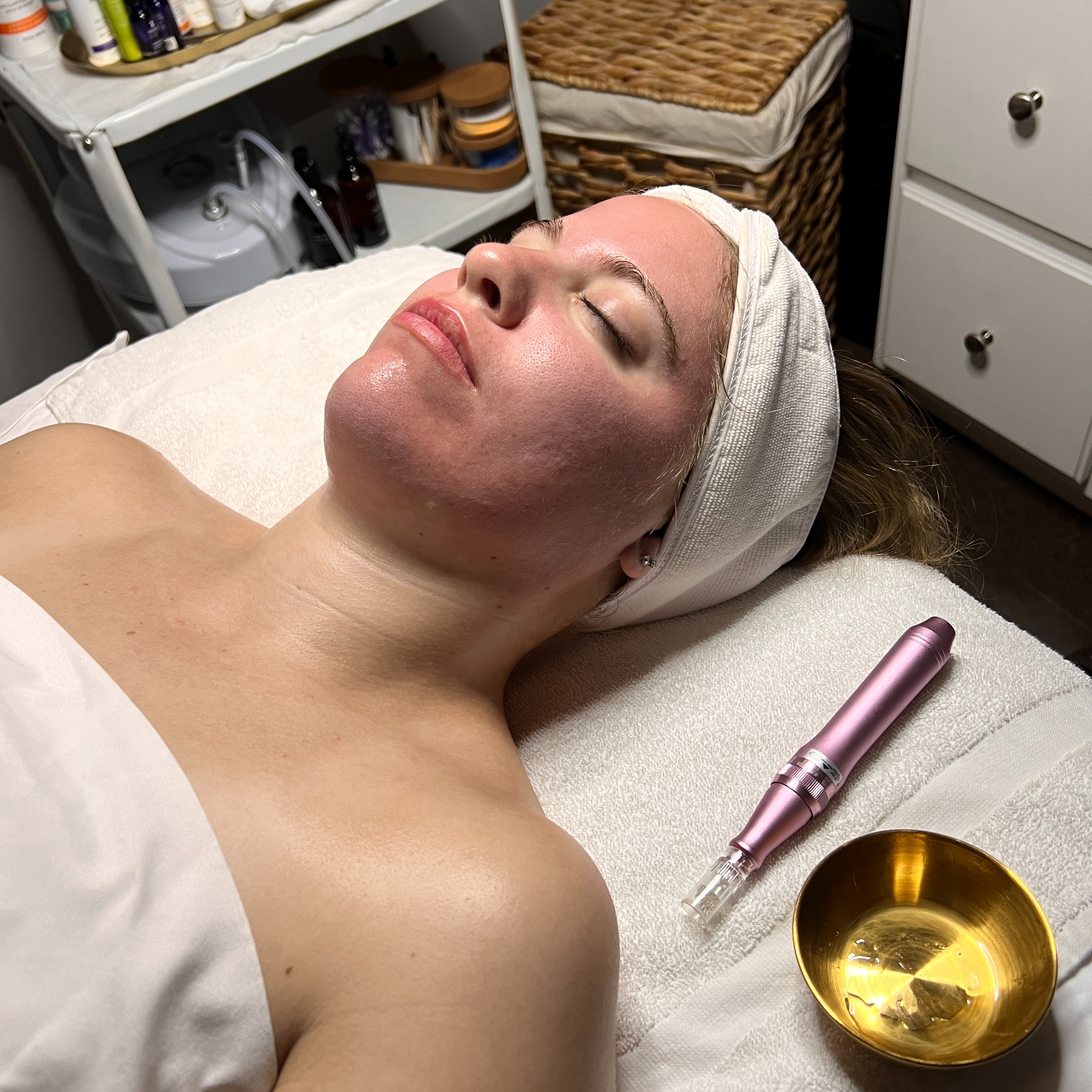 Microneedling-Pkg  of  3 at Serenity Aesthetics by Denise in St. John’s, FL