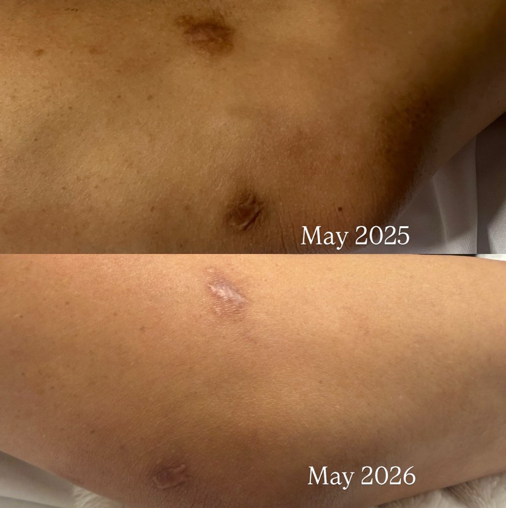 Body Scar Microchanneling at Glow Getter Facialist in Dallas, TX