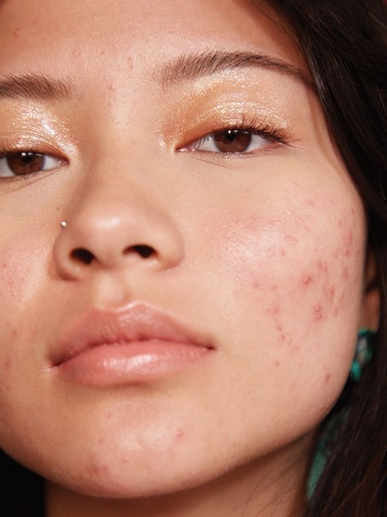 Clear Skin Acne Facial