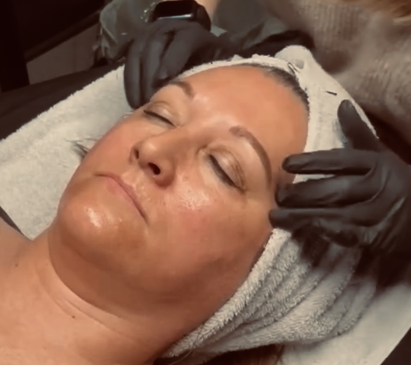 Chemical Peel Treatment