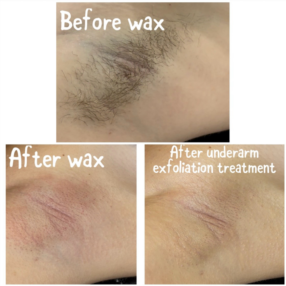 Underarm Exfoliating Treatment at Enhanced Beauty in Gillette, WY