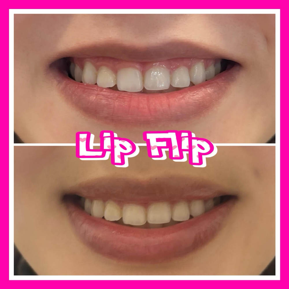 Lip Flip