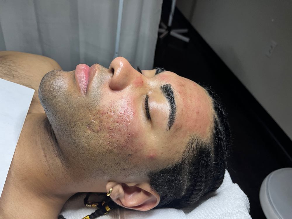 Microneedling Facial