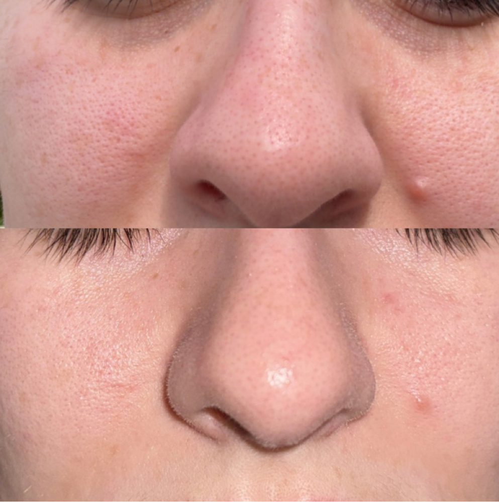 SkinPen Microneedling 💉 at Cereza Skin and Laser in Tempe, AZ