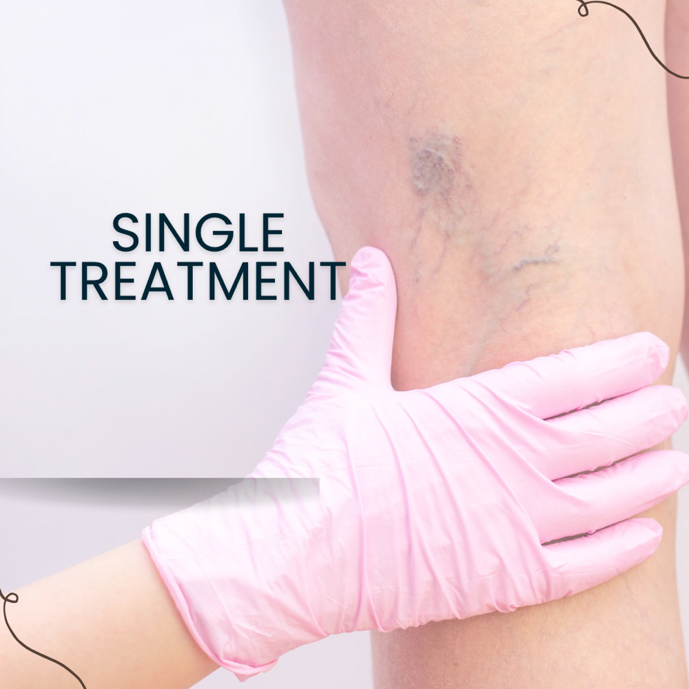 Varicose Vein Leg Treatment at PRYSM LIGHT in West Burlington, IA