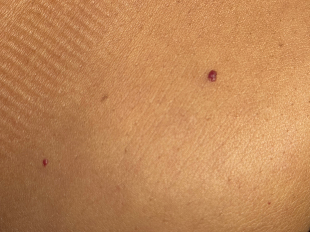 Cherry Angioma Removal