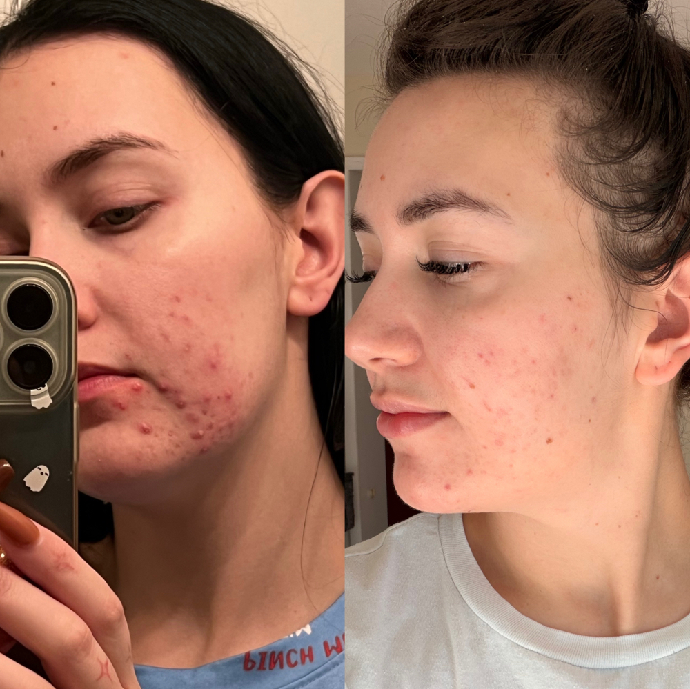 Acne Bootcamp- Consult + Facial