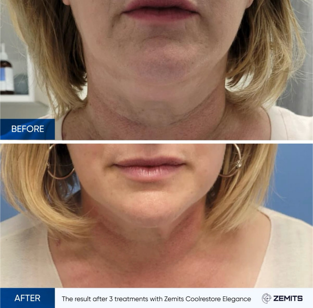 Cold Restore Chin And Neck