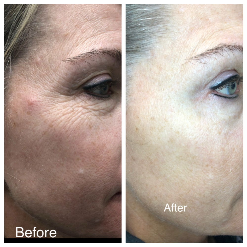 Plasma pen at Marco Island Aesthetics