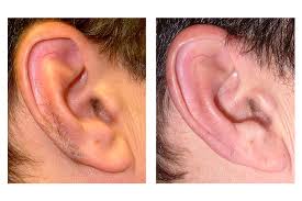 Waxing - Ear