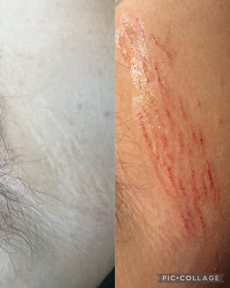 Stretch Mark/Scar Camo: Arms