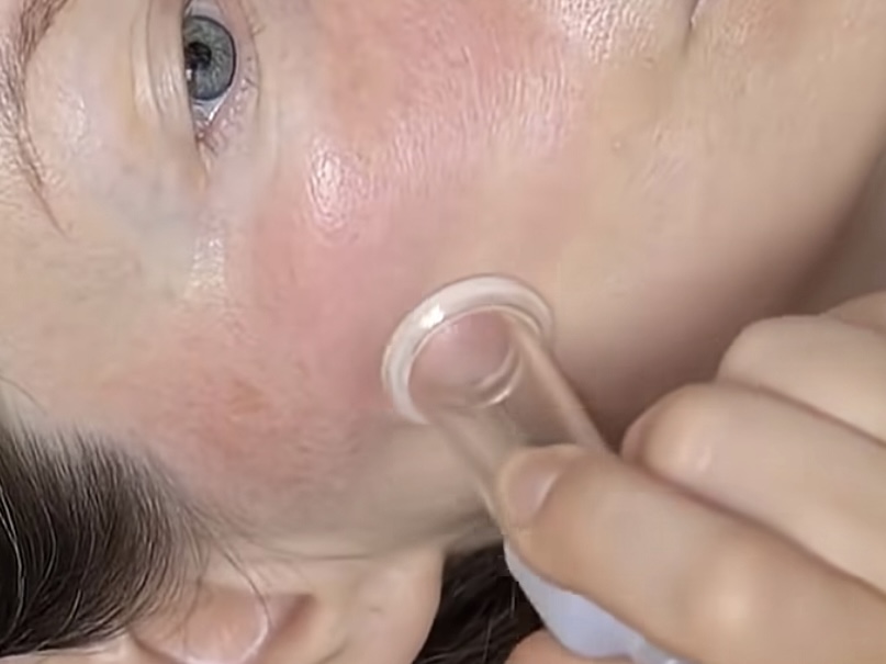 FACE CUPPING LYMPHATIC DRAINAGE