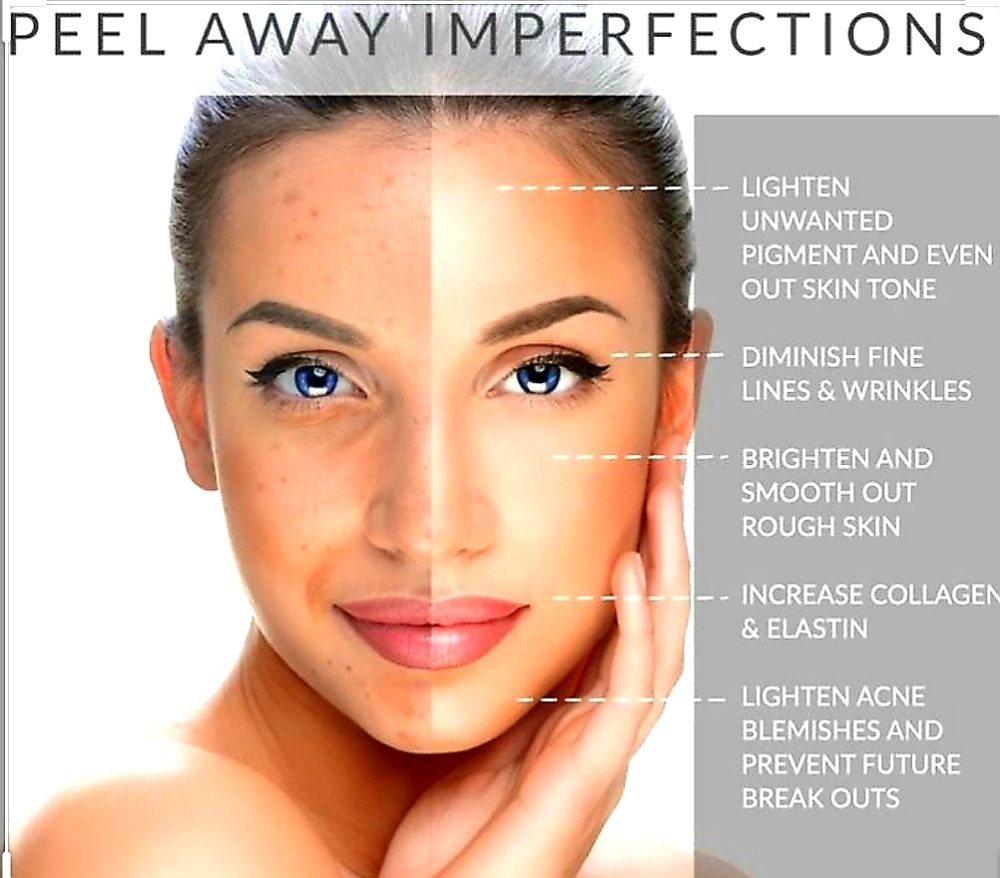 Chemical Peel