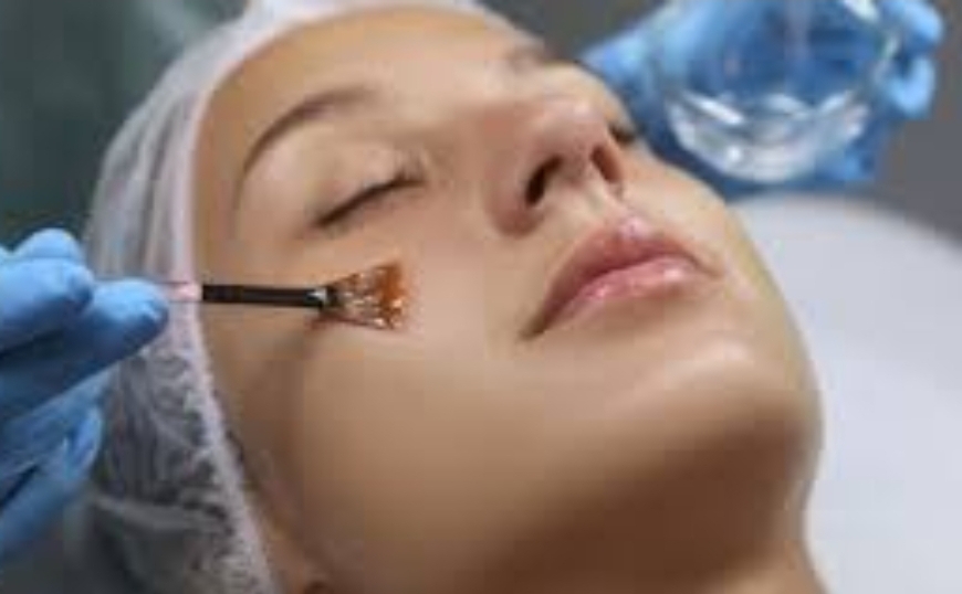 Chemical Peel