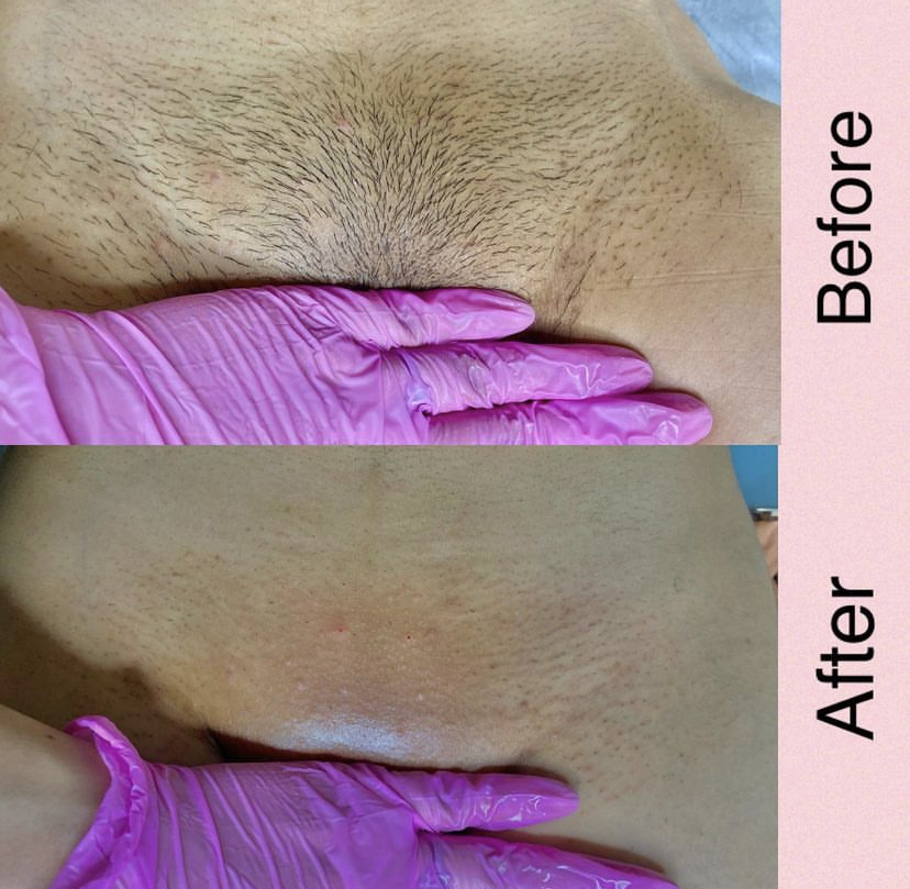 BRAZILIAN WAX