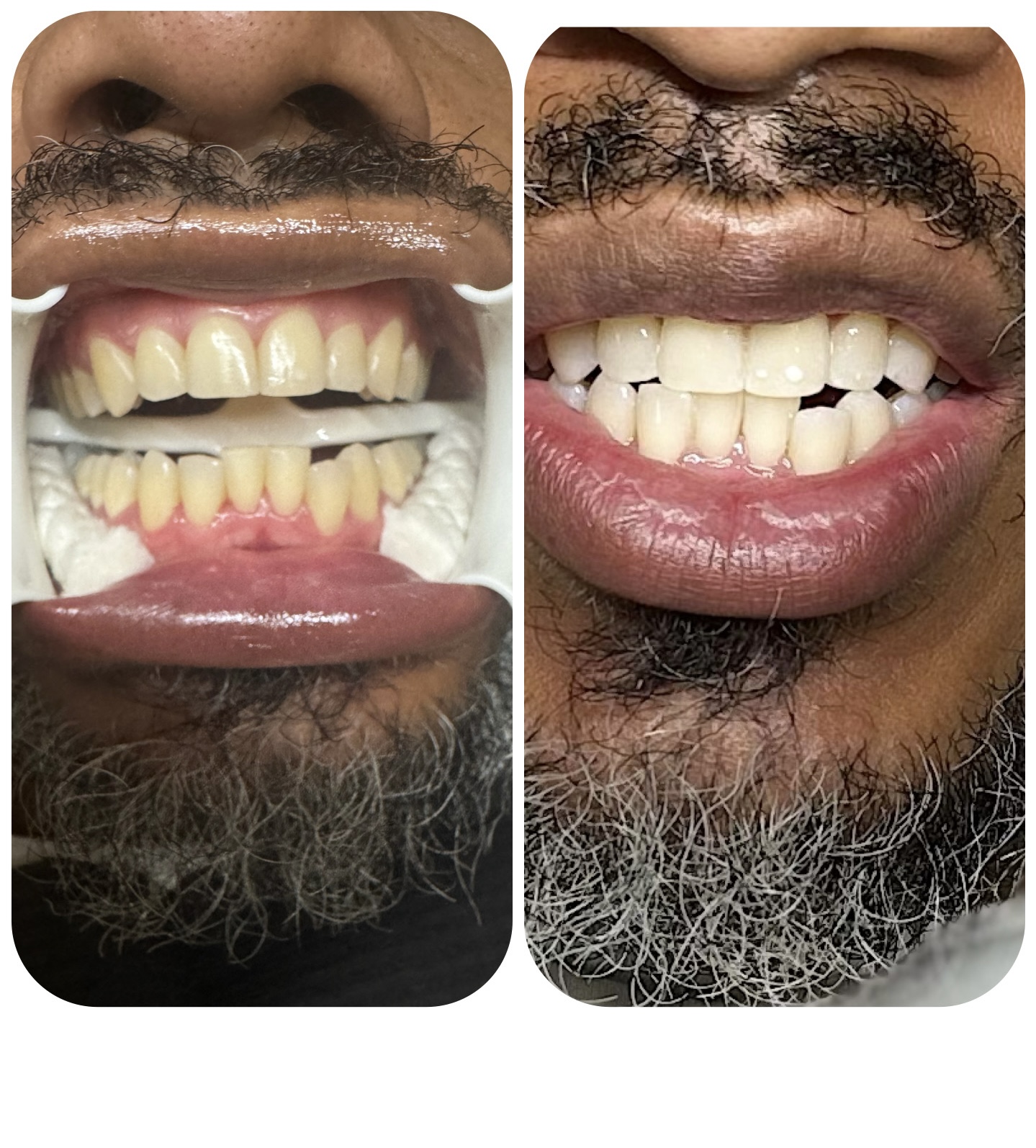 Ultimate Teeth Whitening