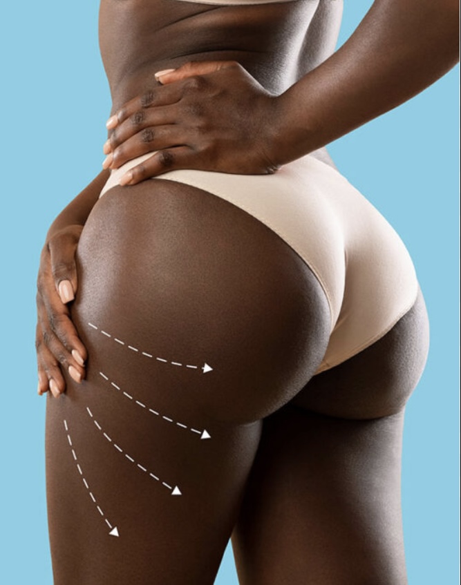 Non-Surgical Butt Lift🍑