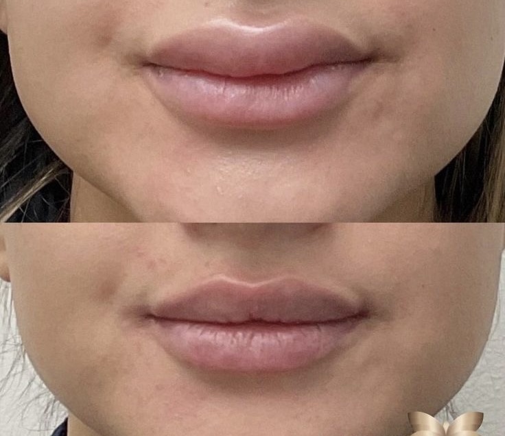 Lip Filler Dissolve