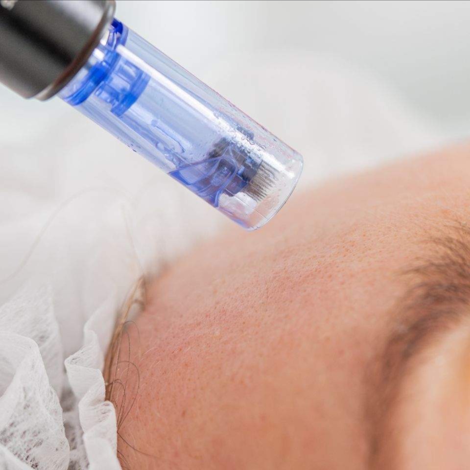 Microneedling W/ Hyaluronic Acid at Crown of Beauty Wellness, LLC in Floresville, TX