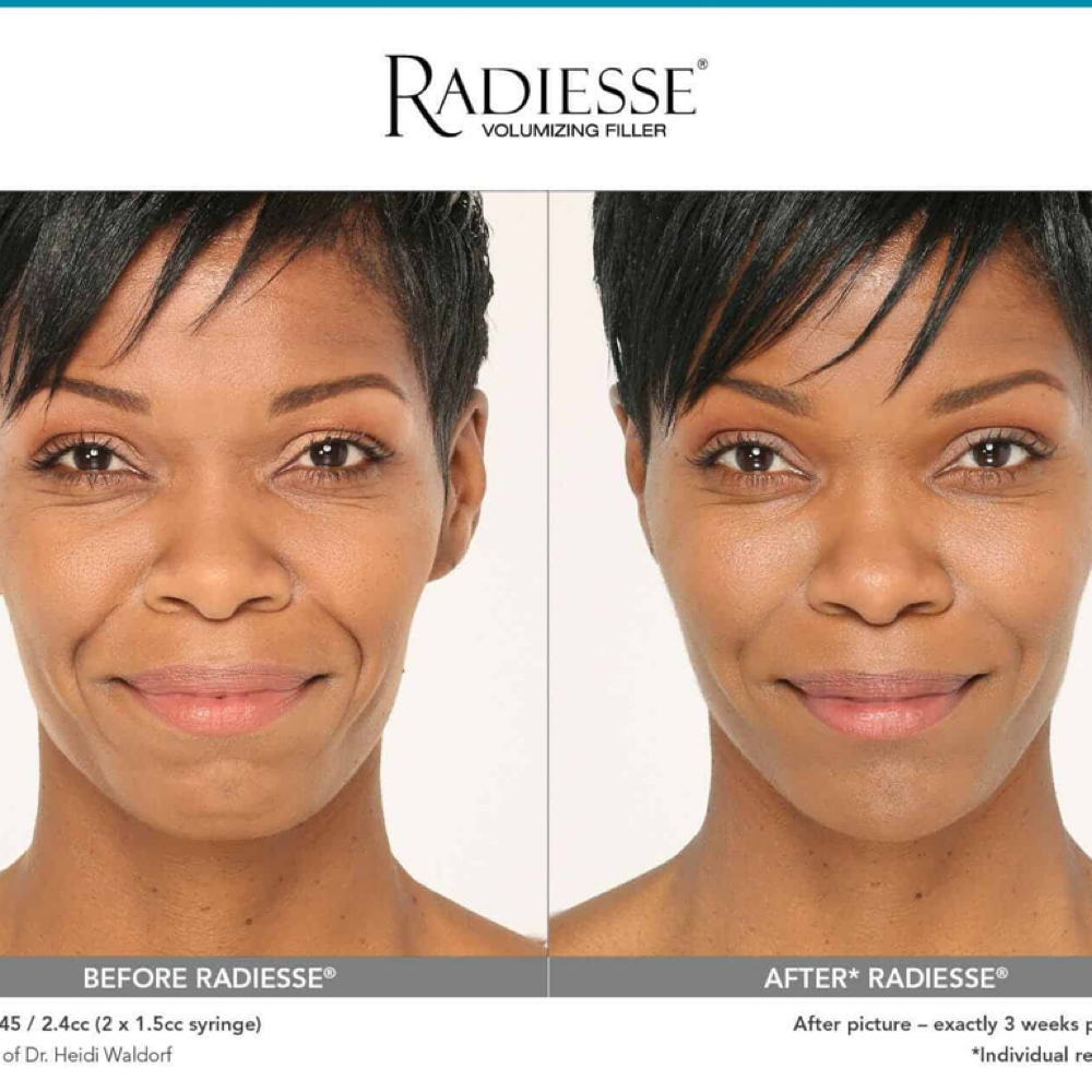 Radiesse Special ✨ at Bella Rose Aesthetics in San Antonio, TX