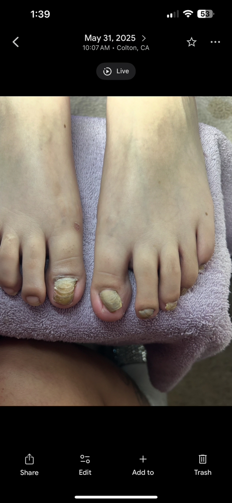 ACRYLIC SEVERE FUNGUS at NailsByChachiis in Colton, CA