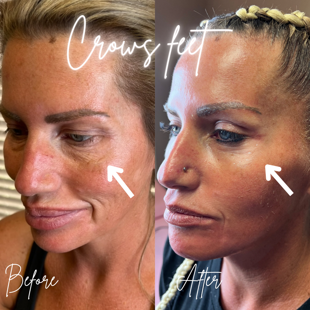 Tox-Micro Tox Under Eye💉 at BeautyHolic Aesthetics LLC in Lubbock, TX