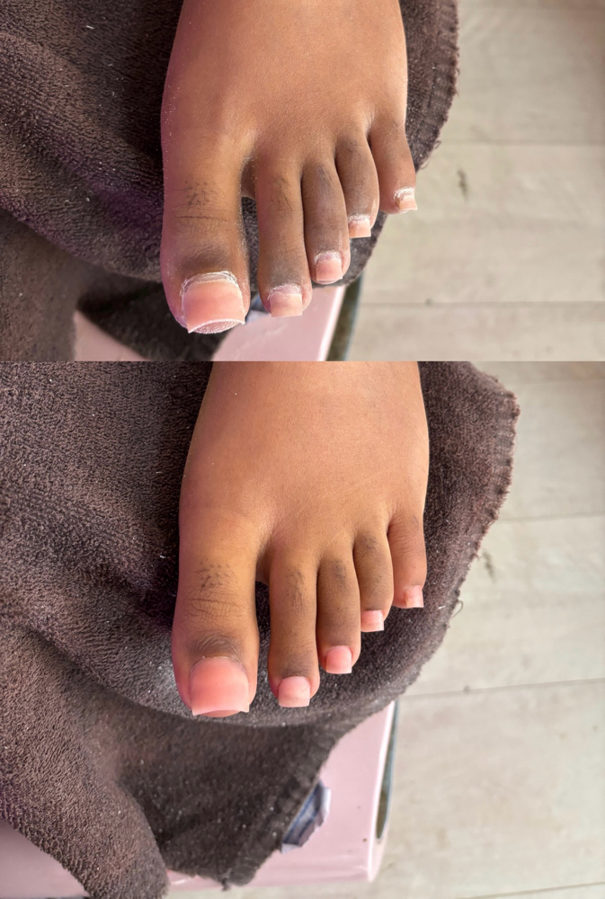 Fill-in (toes)