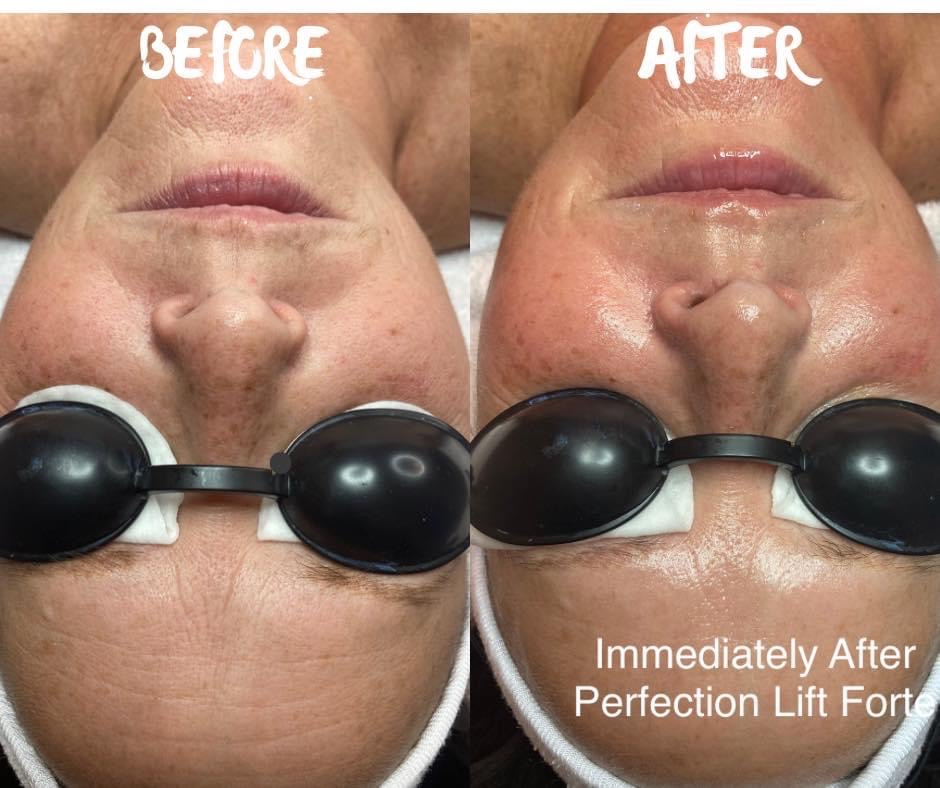 Chemical Peel 6 Series
