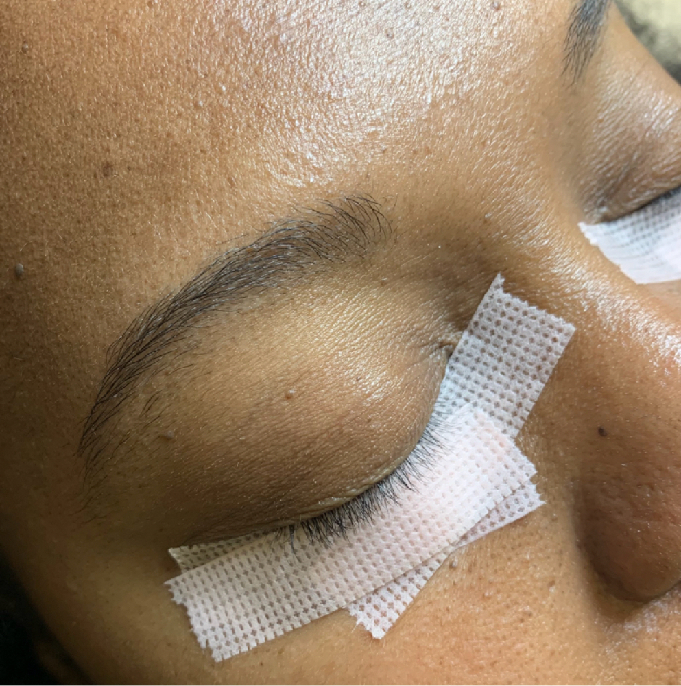 Cluster Removal w/New Set at Culture Aesthetics in Orange City, FL