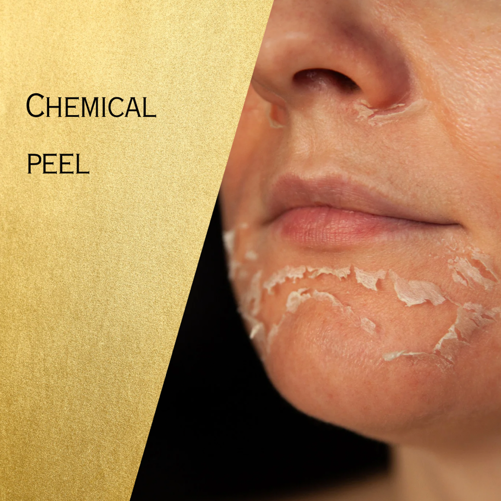 TCA 30-35%/VI Chemical Peels