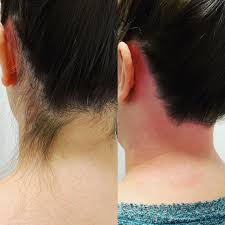 Waxing-Hairline