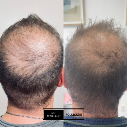 Follicure Hair Restoration Treatme at Flawless Finish Skin Renew in Lagrange, NC